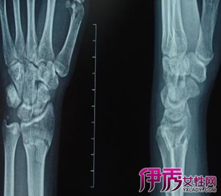 手腕骨折后注意事项|life.yxlady.com