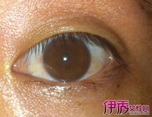 眼白发黄什么原因|life.yxlady.com
