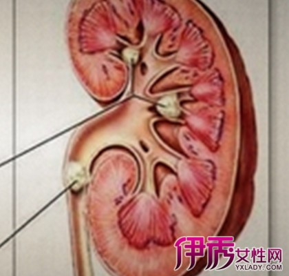 肾结石尿血怎么回事|life.yxlady.com-伊秀生活小