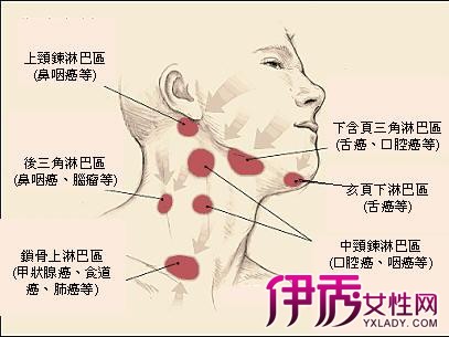 頸部淋巴結腫大的原因