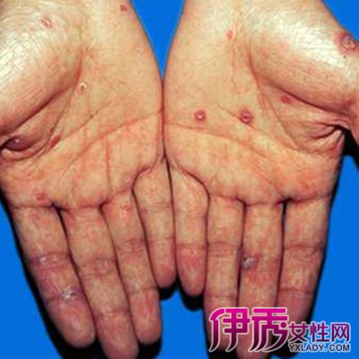 【图】阐释梅毒是什么样的症状 七点预后注意事项值得借鉴