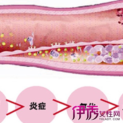 颈动脉硬化_动脉硬化的症状