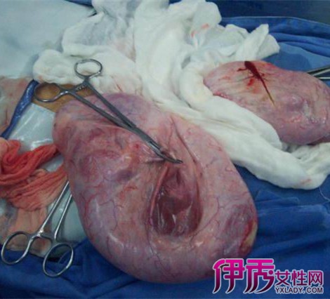 宫颈囊肿怎么做手术图片
