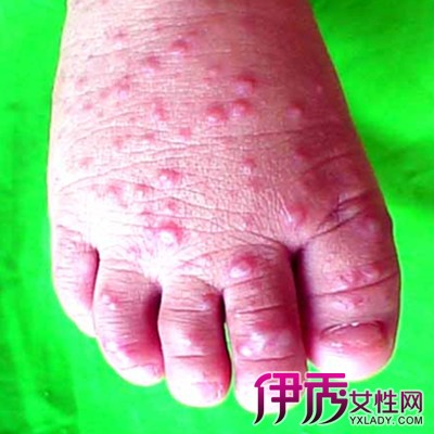 手足口病图片初期治疗_手足口病怎么治疗